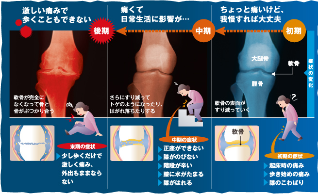 すぎやま病院 健康コラム 関節痛 について