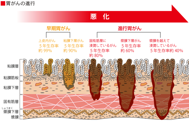 胃がんの進行