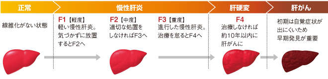 症状 ん 肝臓 が 初期 ［医師監修・作成］肝臓がんの症状：初期症状から進行した場合の症状を解説