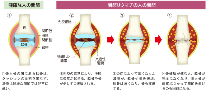 関節リウマチの人の関節