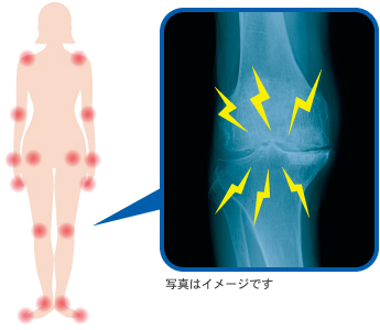 関節リウマチの関節リウマチの主な主な罹患関節